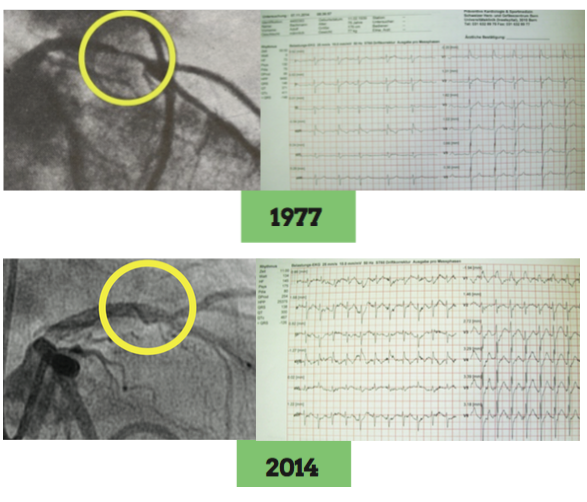 First PCTA: Follow-up comparison from 1977 to 2014