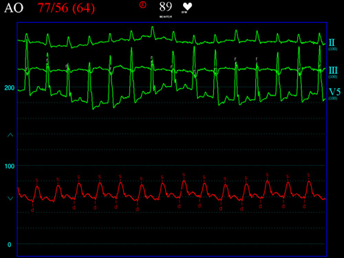 Hypotension during RA