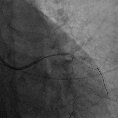 Proximal LAD stenting with 3.0 x 22 mm DES