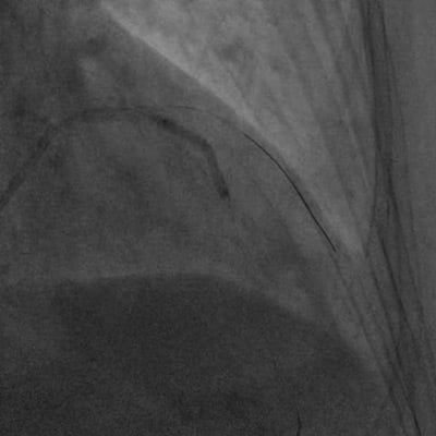Mid LAD dilatation with 2.5 mm NC balloon