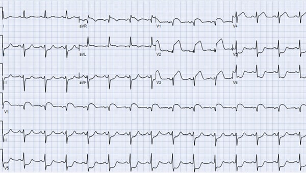 83-year-old woman with arterial hypertension ECG