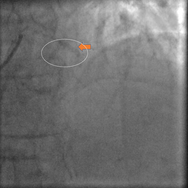 Large LAD Tight stenosis 