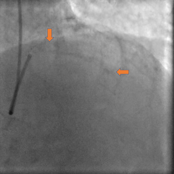 Vessel calcification
