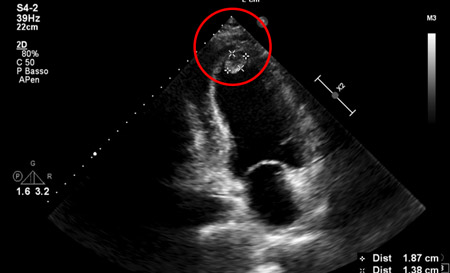 Akinesia of the apex with thrombus formation