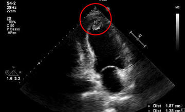 Akinesia of the apex with thrombus formation