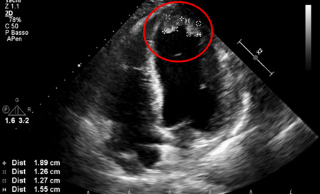 Akinesia of the apex with thrombus formation