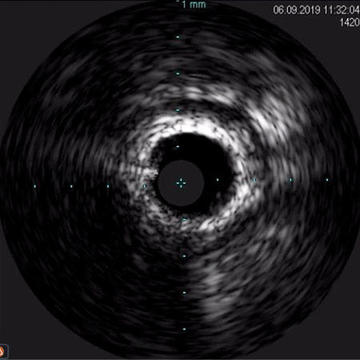 Non-fractured circumferential calcification