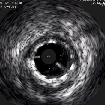 Distal stent