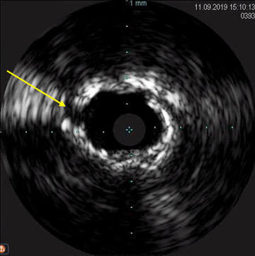IVUS showing adequate plaque modification