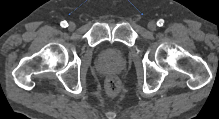 Common femoral arteries