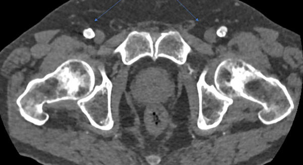 Common femoral arteries