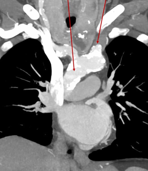 Porcelain aorta and occluded  left common carotid artery