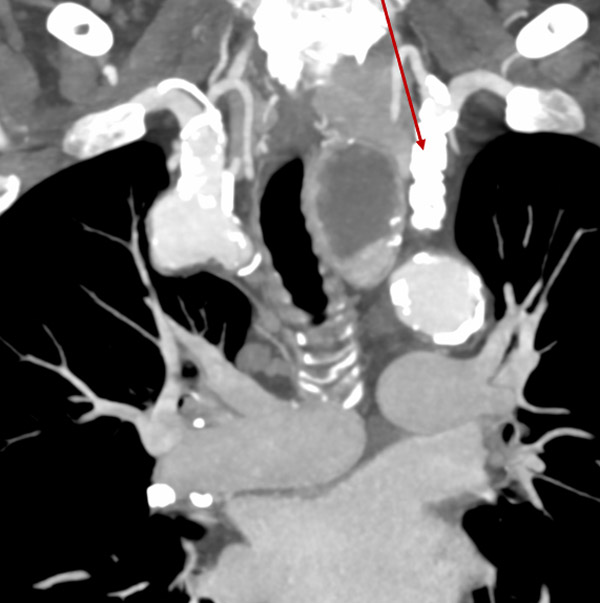 Occluded subclavian artery