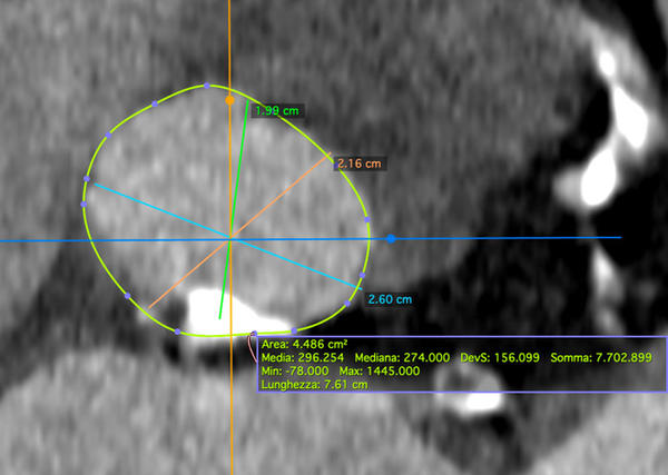 LVOT