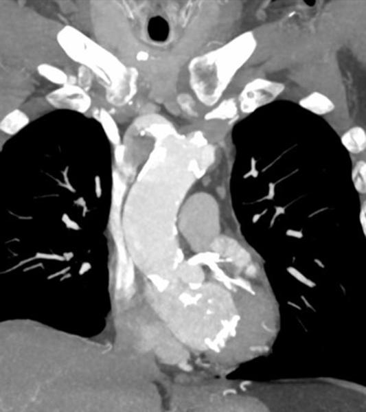 Massive calcification of the LM and LAD/LCx