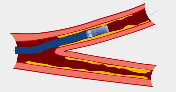 Step 4: mother in child catheter in place