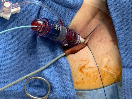 The clip should be secured after insertion of prosthesis delivery sheath