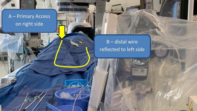 A – Primary Access on right side, B – distal wire reflected to left side