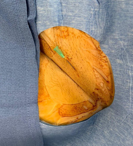The tip of the needle should be secured below the skin of the patient
