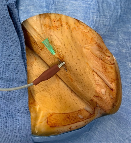 The tip of the needle should be secured below the skin of the patient