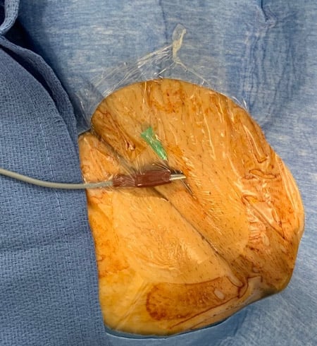 The tip of the needle should be secured below the skin of the patient
