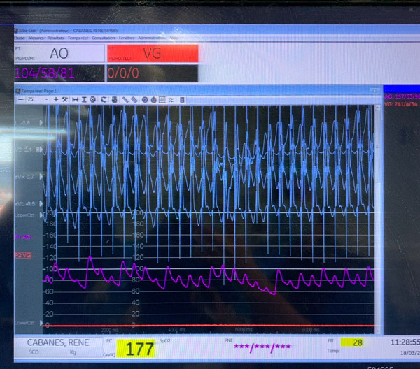 Testing pacing response