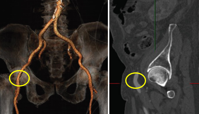 Figure 1: Puncture site should be in projection to the femoral head 