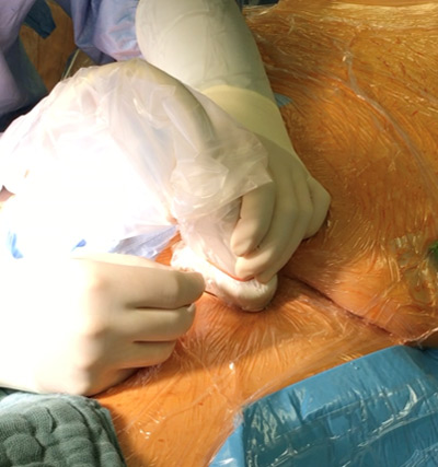 Figure 3: Positioning of the ultrasound probe and the needle.