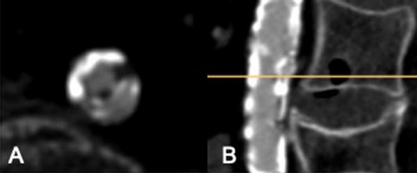 Figure 2: CT-scan with severe circular calcified abdominal stenosis (diameter 5x3mm) (A: axial B: sagittal)