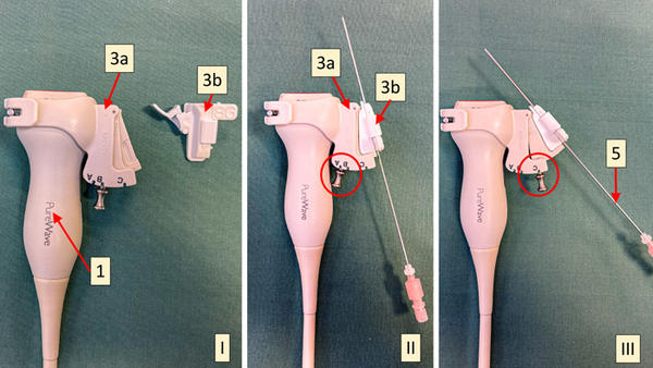 Picture 1: Ultrasound probe (1) with non-sterile part of the needle guide (3a) attached, sterile part of the needle guide (3b) at the side (I), sterile part attached to the non-sterile part (sterile cover between sterile and non-sterile part not shown), in angle A (II), same as (2), but angle C (III). 5: 18G puncture needle