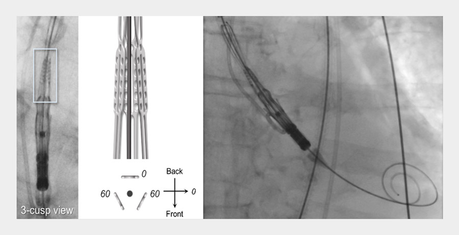 Figure 11: I-I-I fluoroscopic appearance of the 3 commissural posts of the Acurate noe2 valve in the 3-cusp view with the central post located posteriorly, corresponding to correct alignment.