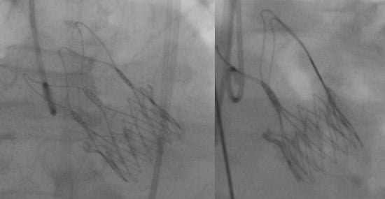 Figure 19: Correct configuration of the Acurate neo 2 valve after implantation on 3 cusp view (I-I-I configuration, left panel) and cusp-overlap view (II-I configuration, right panel)