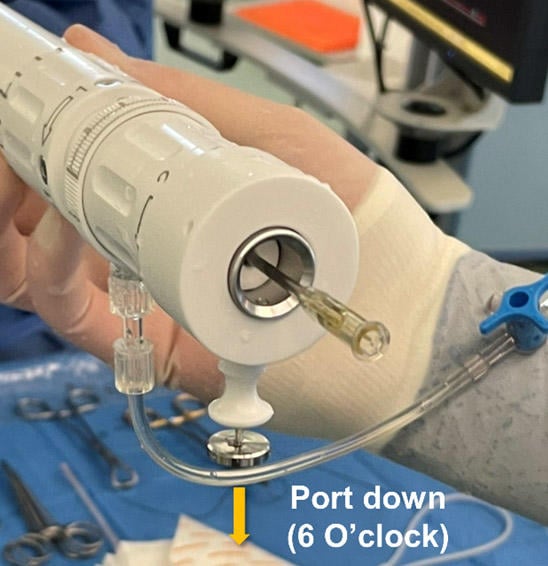 Figure 9: Introduction of the Acurate neo2 platform with the flushport at 6 o’clock. Reproduced with permission from ref. 1