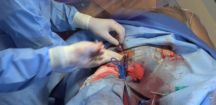 Step 10 – Establish antegrade perfusion