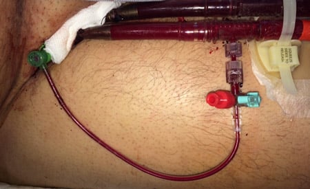 Step 11 - c - Connect to arterial cannula side port