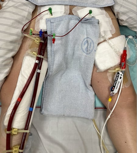 Step 11 - d - Repeat process in case of contralateral large-bore access if deemed necessary, connect with 3-way stop-cock and secure all cannulas and lines with sutures and robust fixation