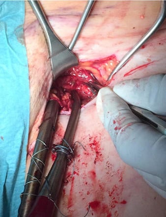 Step 12 - b - Surgical and interventional access site management are additional options in individual cases.