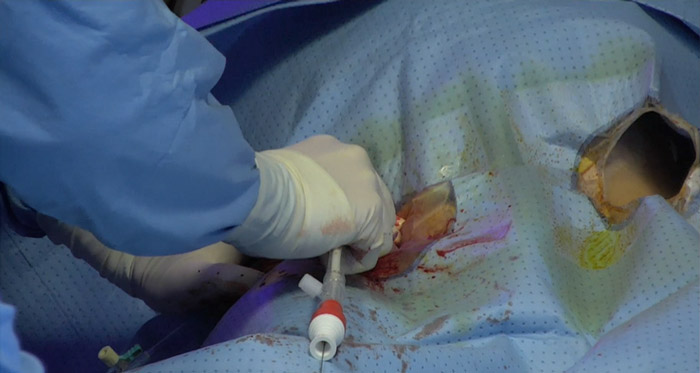 Step 5 - Insert cannula via stiff wire