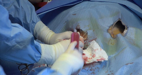 Step 6 - a - Ready the cannula