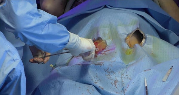 Step 6 – Ready the cannula