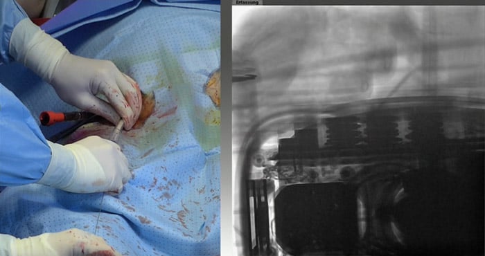 Step 7 - Insert venous cannula
