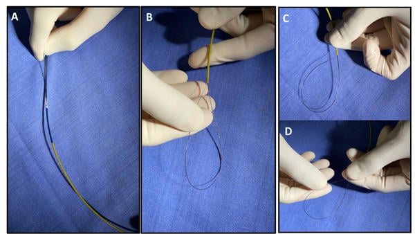 Figure 4 – Step by step homemade snare construction. A) A conventional guidewire and a 2.0mm balloon are inserted into a 6 Fr guide catheter extension (GCE); B) the proximal end (10-20 mm) of the guidewire is looped inside the (GCE) and trapped by the inflated balloon; C-D) Advancing the distal end of the guide wire is possible to modulate the dimension of the homemade snare’s loop.