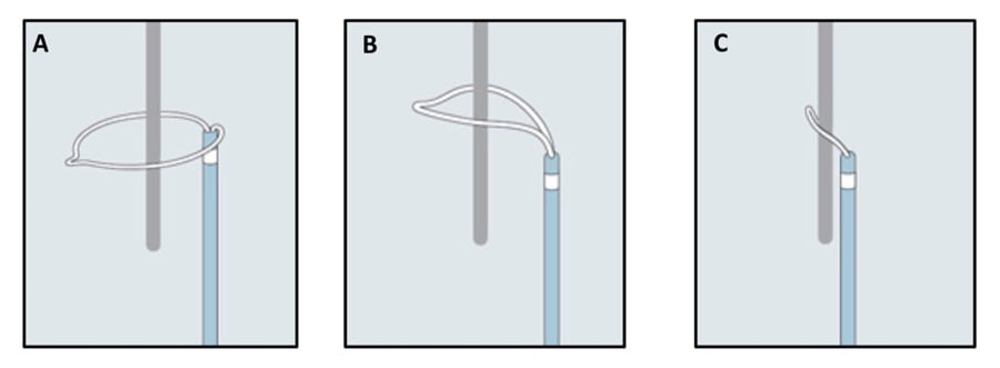 Figure 1 - How a snare works (A-C).  A) Snare catheter in the extended configuration (flowered out); B) Once the capturable body is inside the loop, the snare is tightened; C) The foreigner body is secured by the snare and is ready to be retrieved.