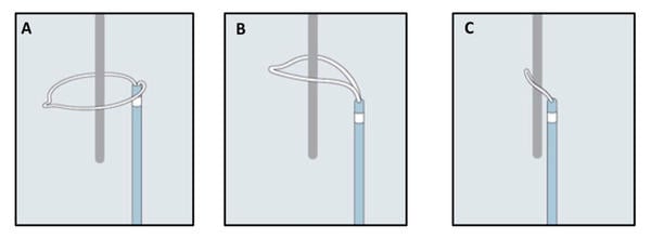 Figure 1 - How a snare works (A-C).  A) Snare catheter in the extended configuration (flowered out); B) Once the capturable body is inside the loop, the snare is tightened; C) The foreigner body is secured by the snare and is ready to be retrieved.
