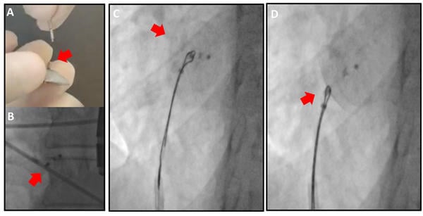 Figure 2 – PFO occluder repositioning. A-B) Protruding metallic bump of PFO occluder, which represents the target for the snaring. C) Occluder snaring and D) repositioning (by a pulling back maneuver of the snare). 