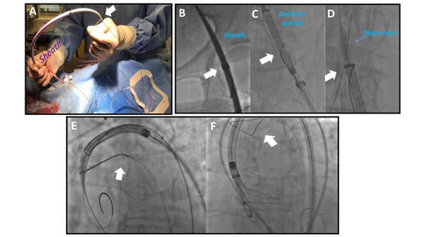 Figure 6 – Bail-out THV snaring due to a porcelain aorta. A) A single-loop snare catheter positioned externally on 18 Fr femoral sheath; B) the snare (white arrow) tied on the sheath after insertion in the vessel; C) the snare (white arrow) positioned and tied at the level of THV's nose-cone after its insertion; D) traction force allowing THV's advancement, witnessed by reduction of the angle pointed-out by white arrow; E) snare (white arrow) removal during valve implantation. 