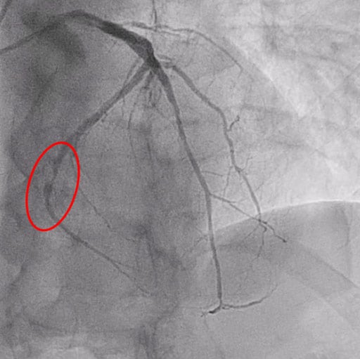 Figure 1: Critical PLCx stenosis