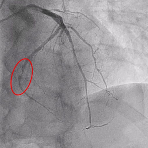 Figure 1: Critical PLCx stenosis