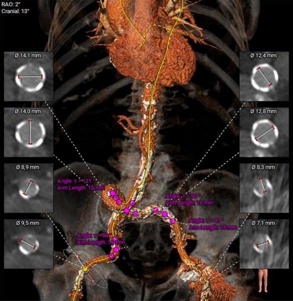Figure 1: CT analysis of the ileo-femoral axis, revealing an extremely tortuous and calcified ileo-femoral pathway
