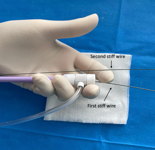 Figure 2: the first stiff wire is placed into the introducer.The second stiff wire is kept outside the introducer and left in contact with the arterial wall